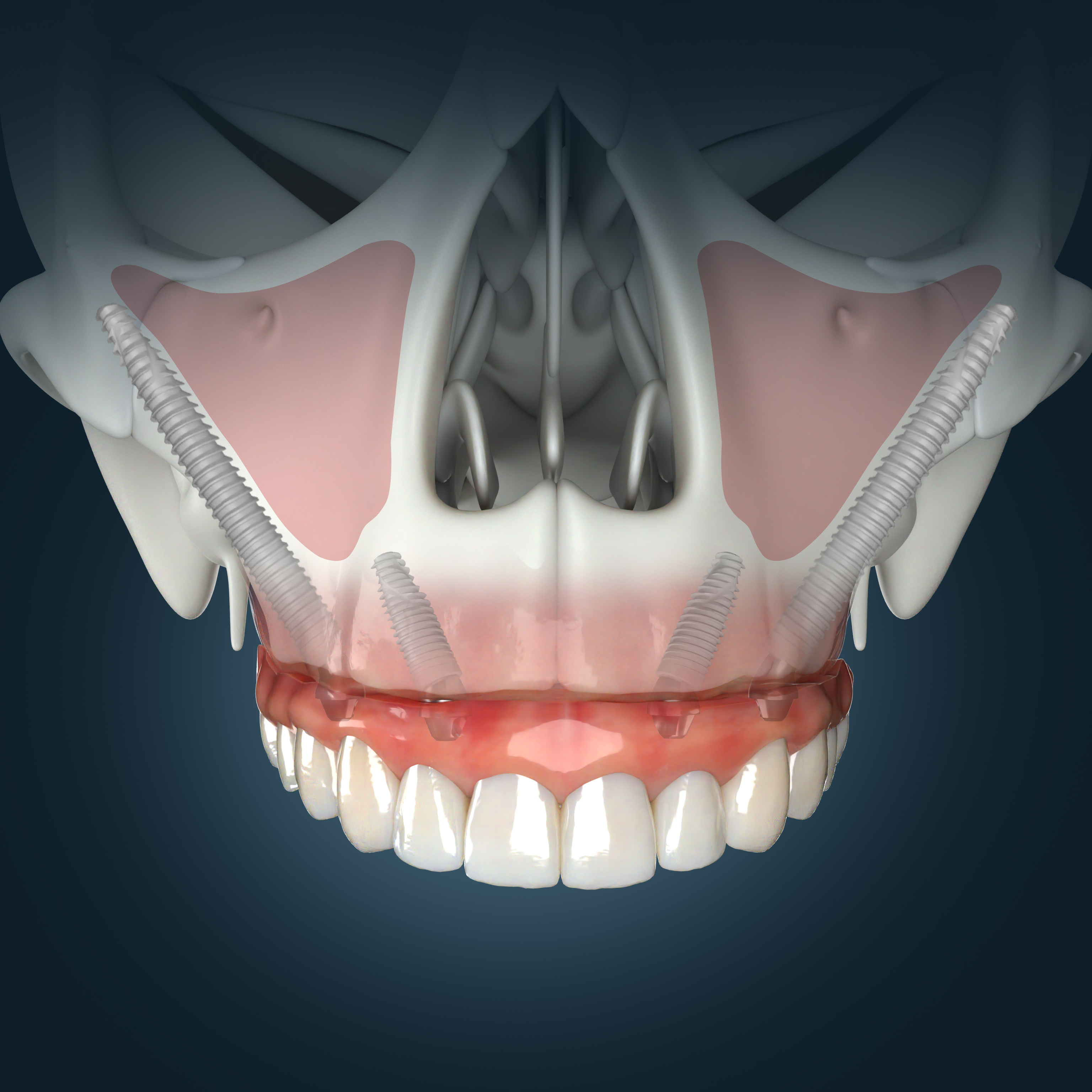 Zygomatic Implant